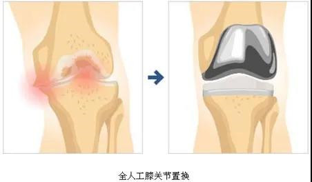 全膝关节置换术后康复注意事项2.jpg 全膝关节置换术后康复注意事项2.jpg