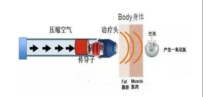 【康复知识小课堂(七)】体外冲击波的临床应用4.jpg 【康复知识小课堂(七)】体外冲击波的临床应用4.jpg
